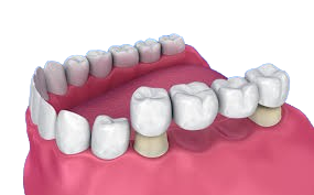 DentalBridges